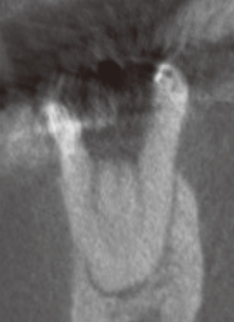 [写真] 根管充填前