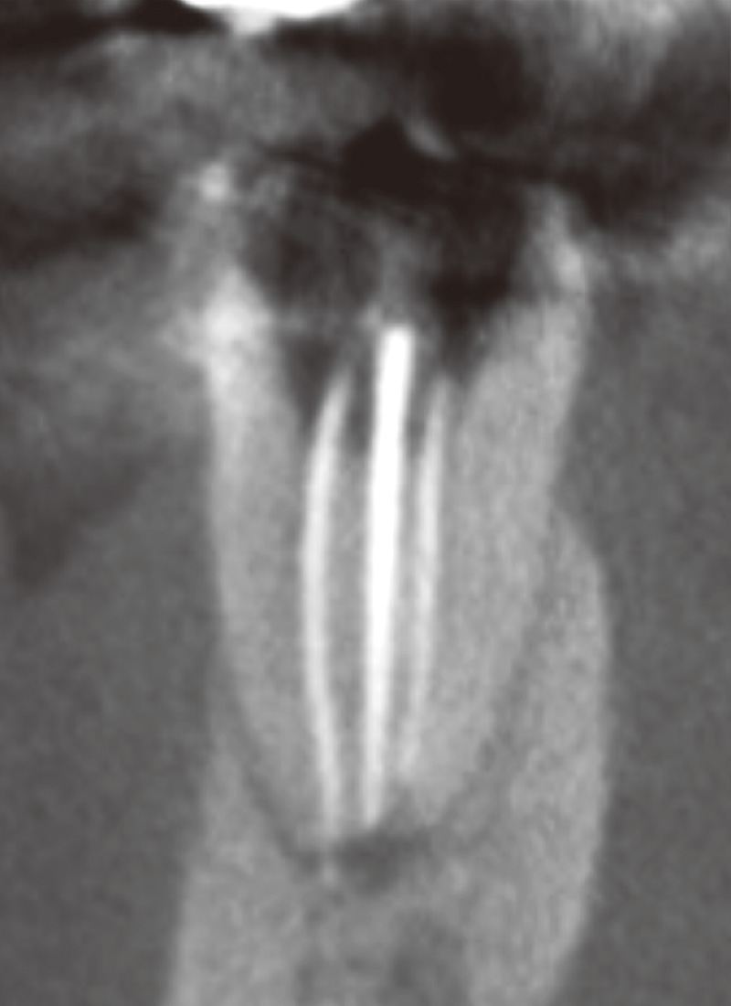 [写真] ガッタパーチャポイント試適時