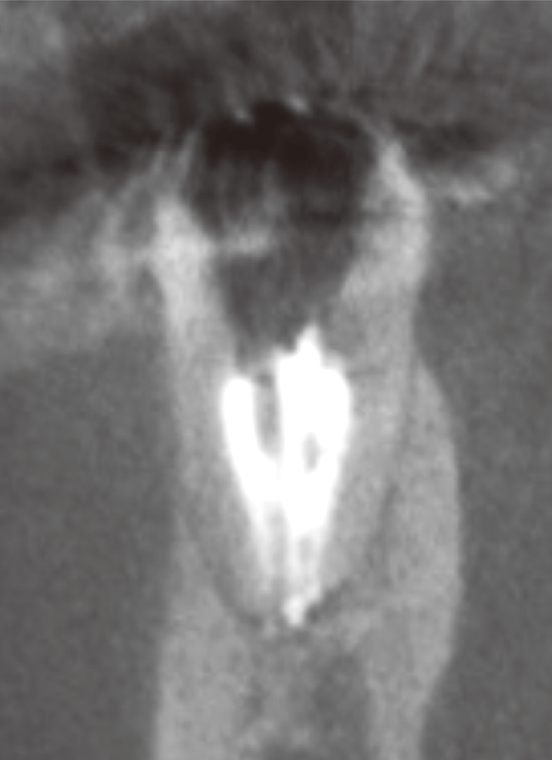 [写真] 根管充填後