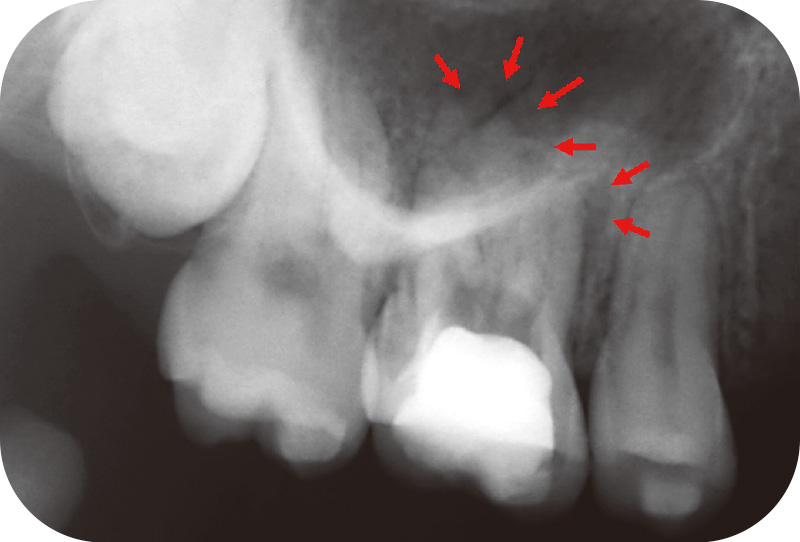 [写真] 初診時デンタルX線画像