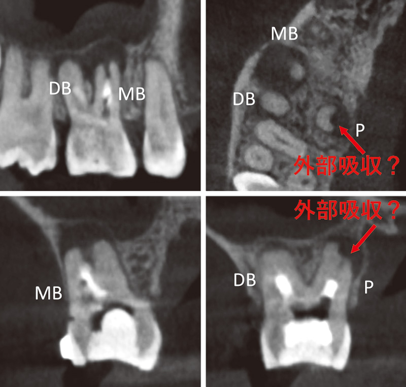 [写真] 初診時CBCT画像