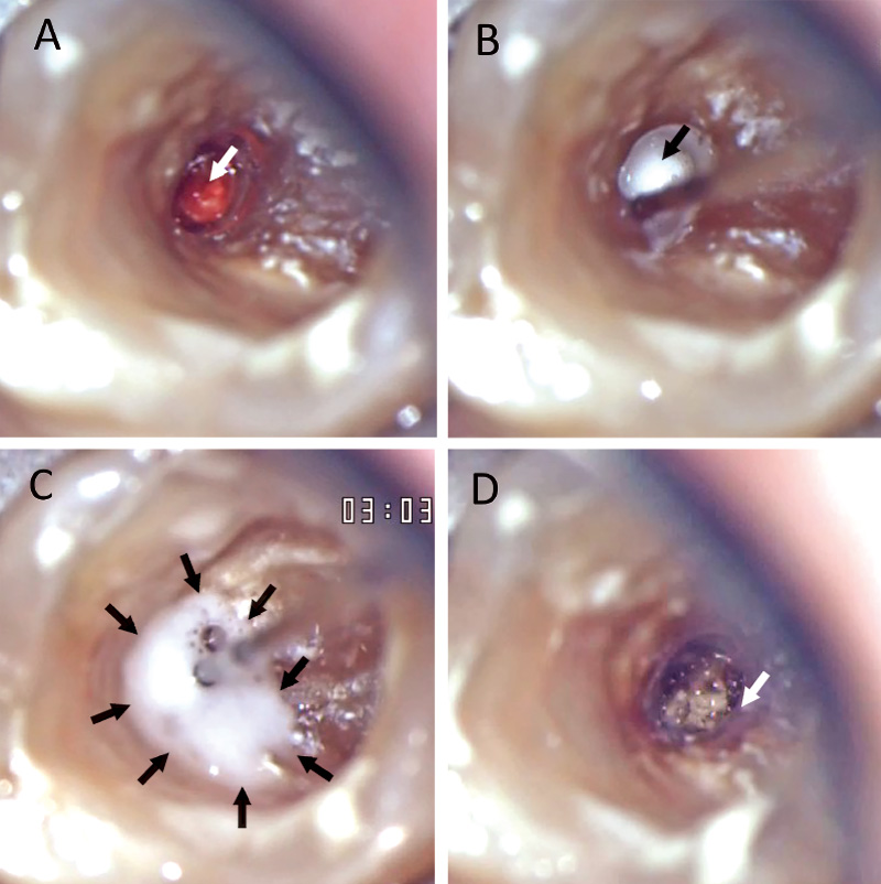 [写真] 口蓋根への通電時