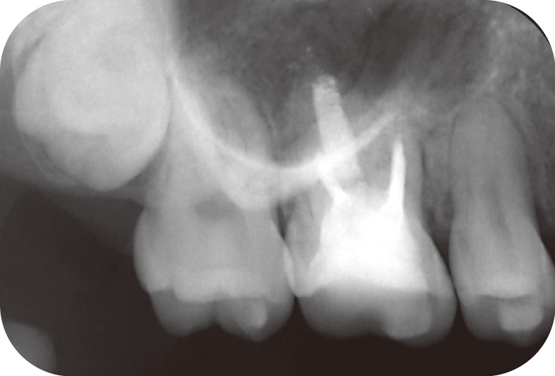 [写真] 通電6か月後（根管充填4か月後）