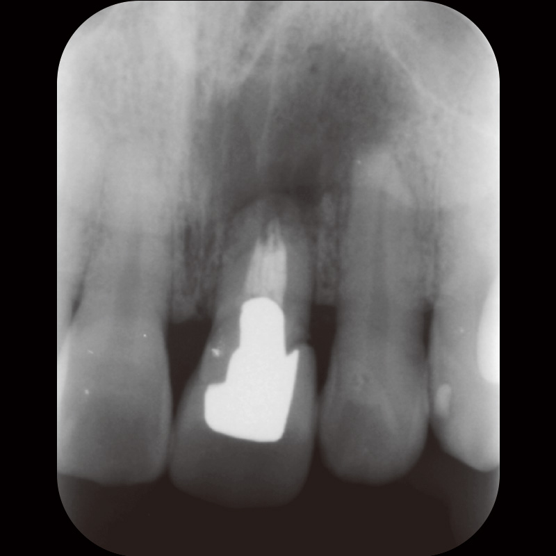 [写真] 初診時デンタルX線画像