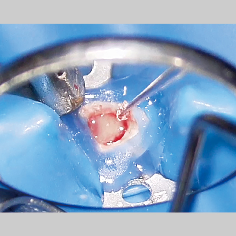 [写真] 多量の排膿