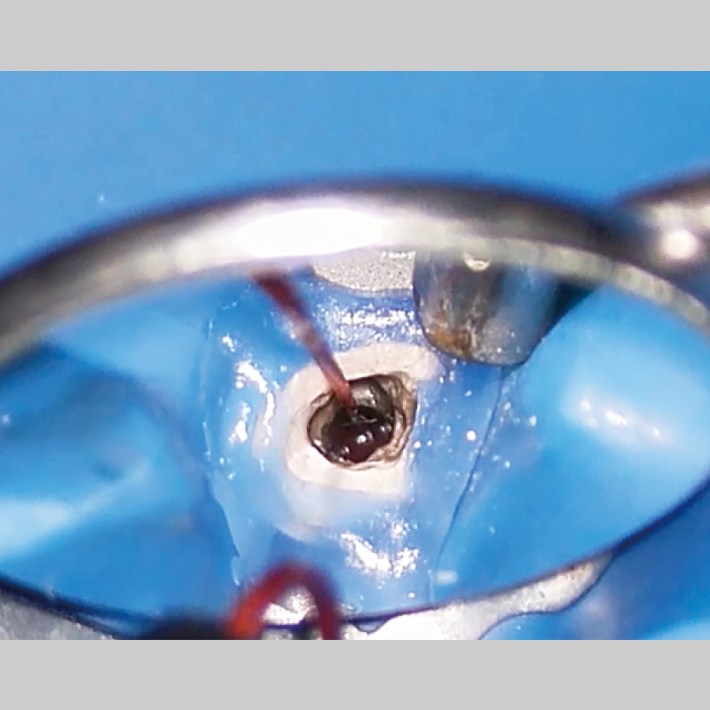 [写真] 高周波通電（HFC）にて焼灼して止血