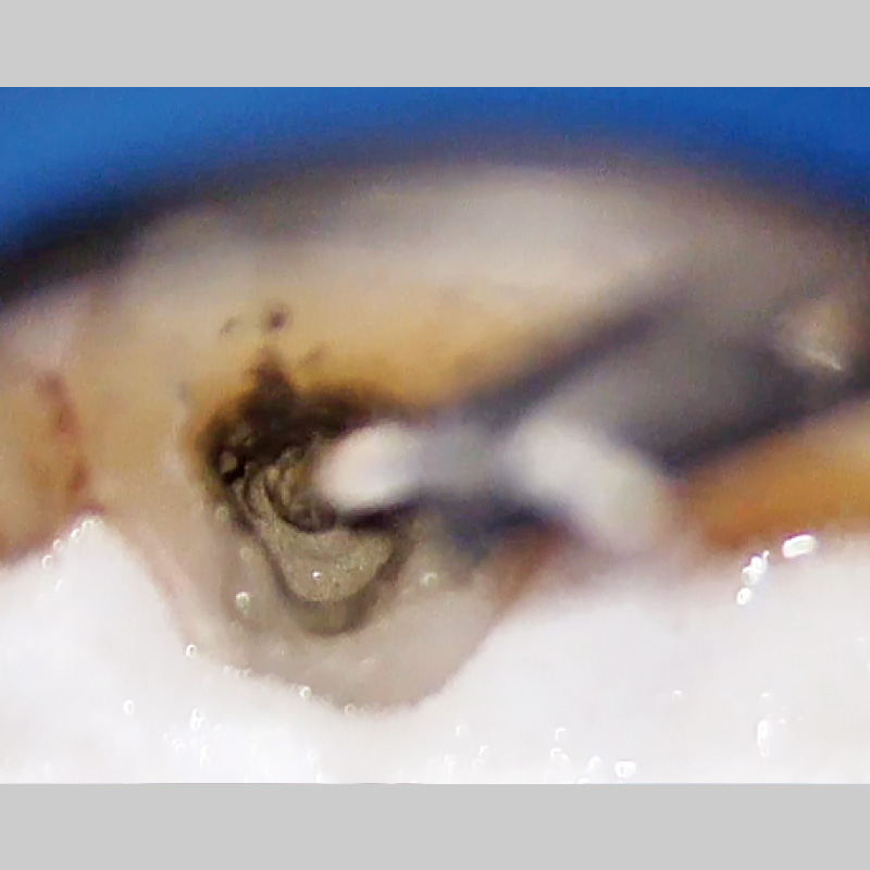 [写真] MTA根管充填症例