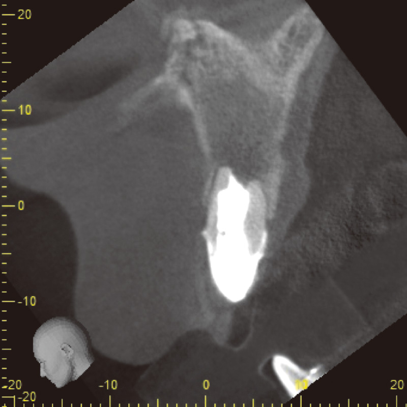 [写真] 根管充填後6か月のCBCT画像