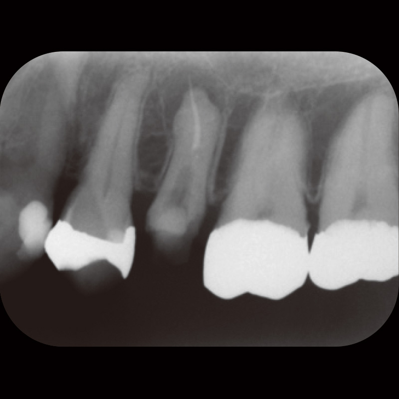 [写真] 初診時デンタルX線画像