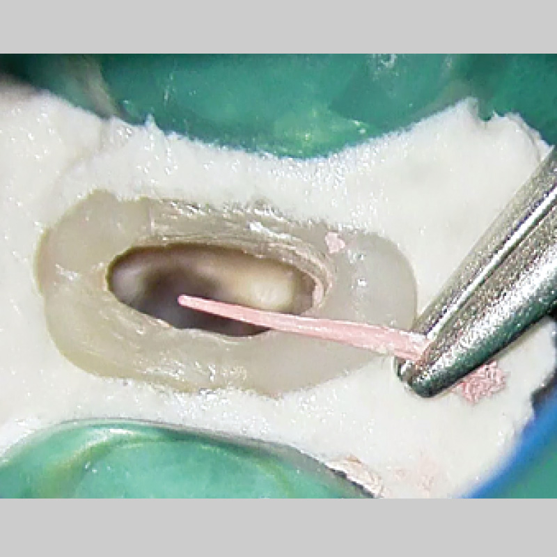 [写真] ガッタパーチャ除去