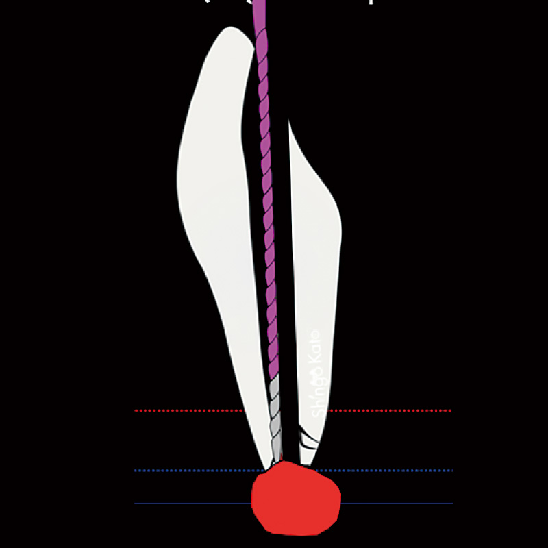 [写真] HFCにて焼灼止血