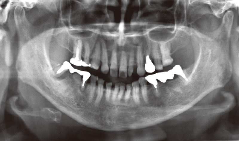 [写真] 術前パノラマX-P