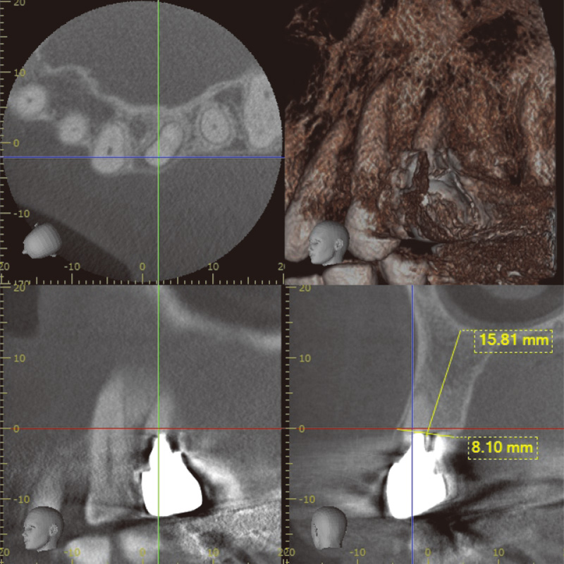 [写真] 術前CT診断