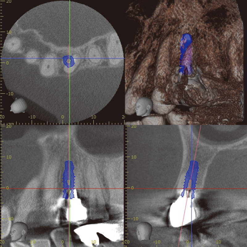 [写真] 術前CT診断シミュレーション