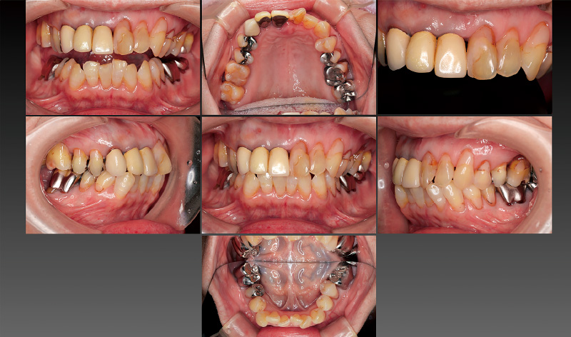 [写真] 主訴部位には不良補綴装置が装着されている