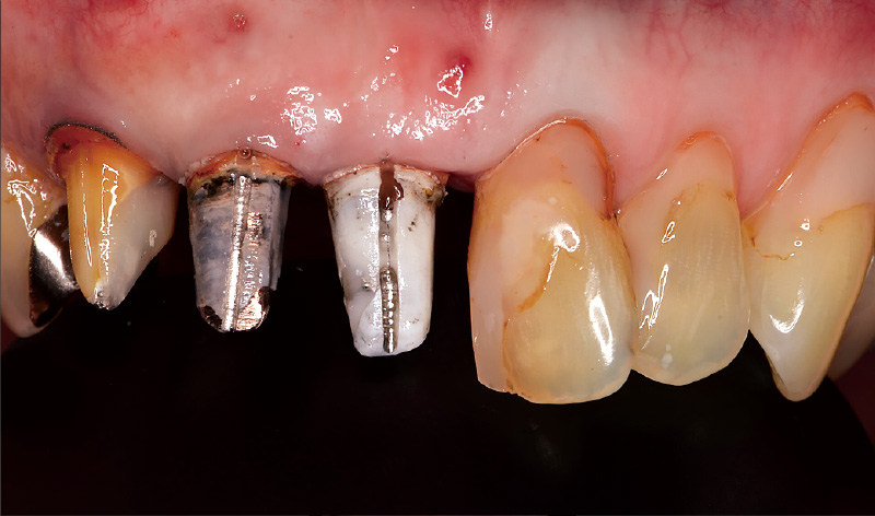 [写真] 不適合なメタルコア、二次カリエスを認める