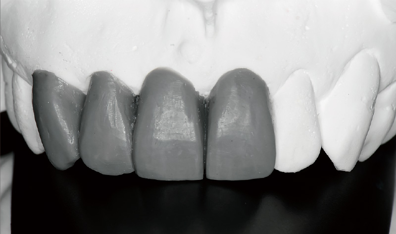 [写真] 診断用ワックスアップにて最終歯冠形態を検討した