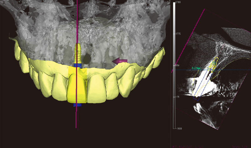 [写真] デジタル上でインプラント埋入ポジションを決定した