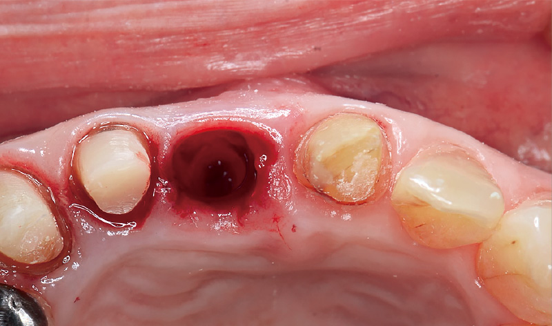 [写真] 周辺組織を傷つけないように愛護的に抜歯を行った