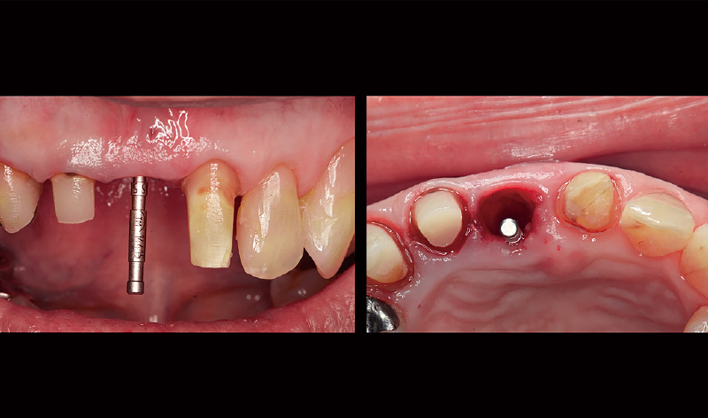 [写真] アライメントピンにてドリリングの方向と深度を確認