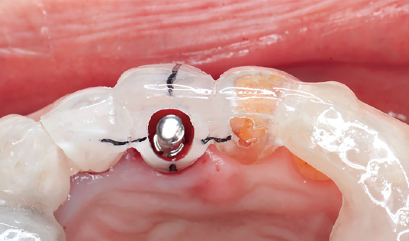 [写真] 埋入を行った