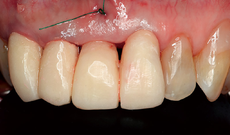 [写真] ホールディングスーチャー後PVRをセットして手術を終了した