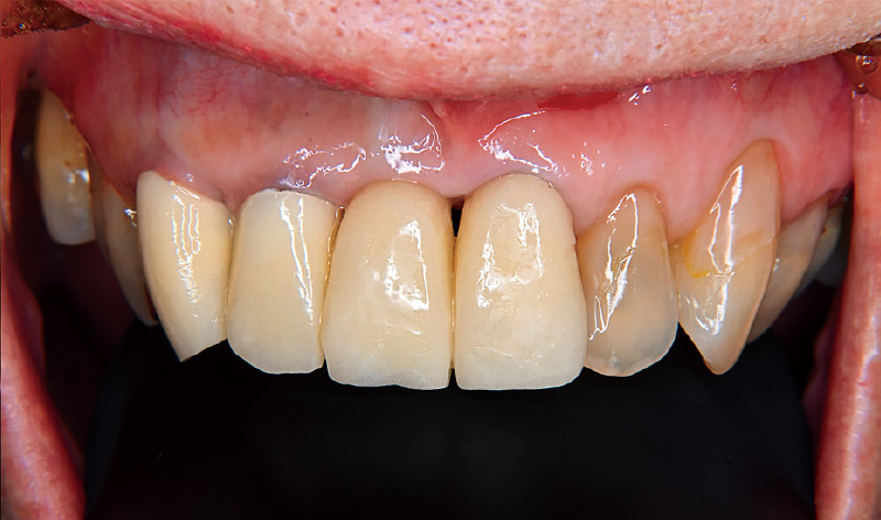 [写真] 2nd PVRにて粘膜形態を調整した