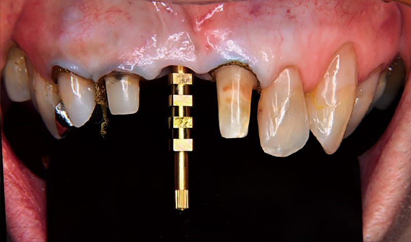 [写真] 問題ないことを確認し、シリコン印象を行った