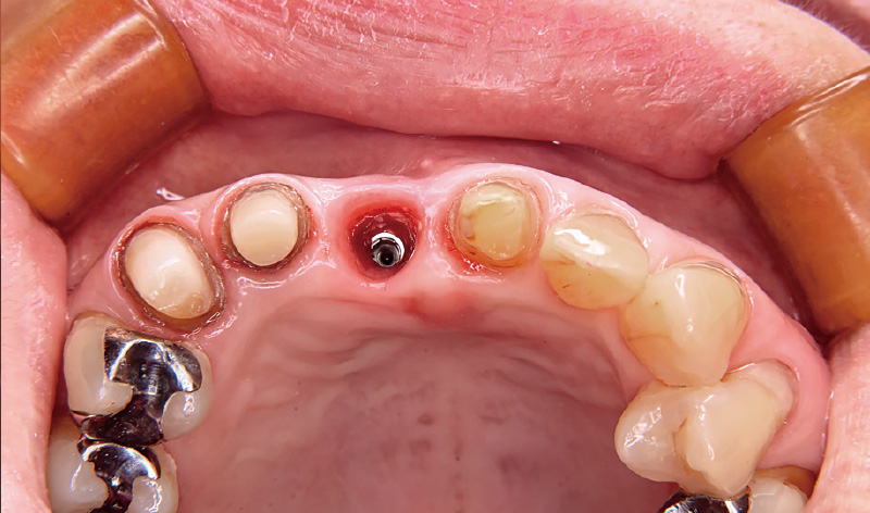 [写真] インプラント唇側には軟組織の厚みが保たれている