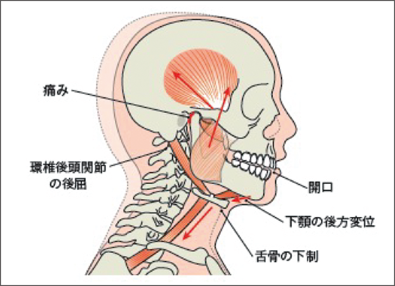 [図] 頭部前方位姿勢