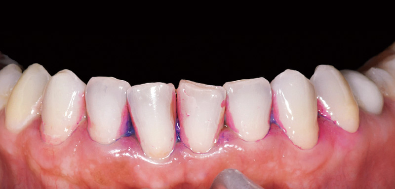 [写真] 歯間部や隅角のプラークが残存している