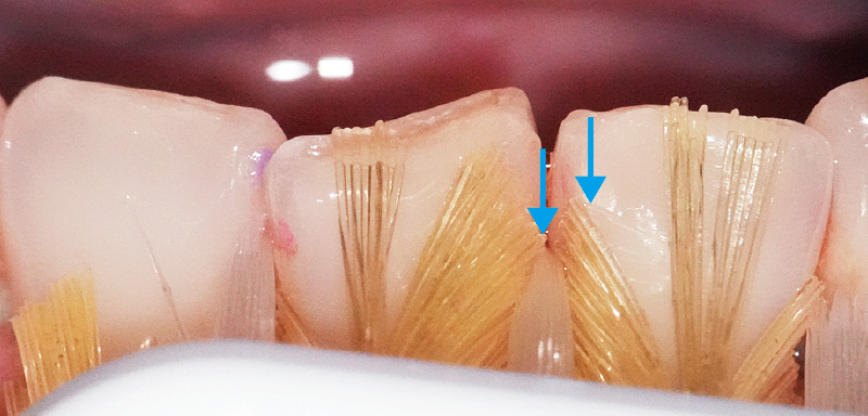 [写真] スーパーテーパード毛が歯間部に入り込み、ラウンド毛が隅角に沿う