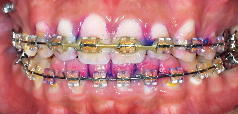 [写真] ブラケット周囲にプラークの残存を認める