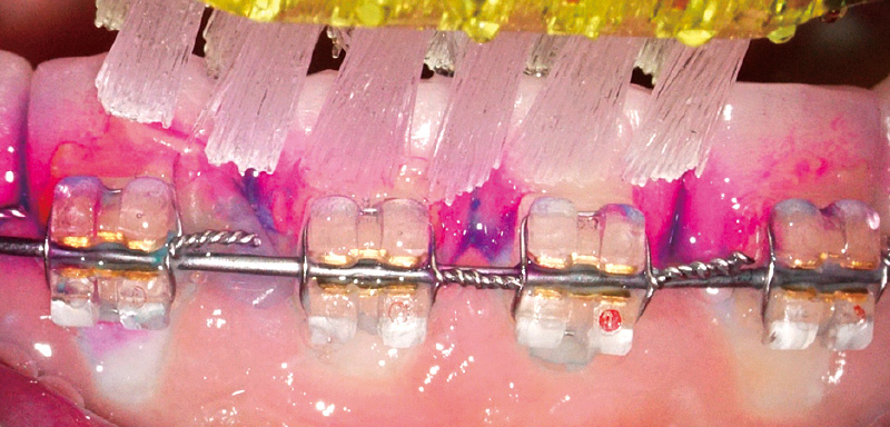 [写真] 歯面のプラークコントロールは可能だが、ブラケット周囲は毛先が到達しない