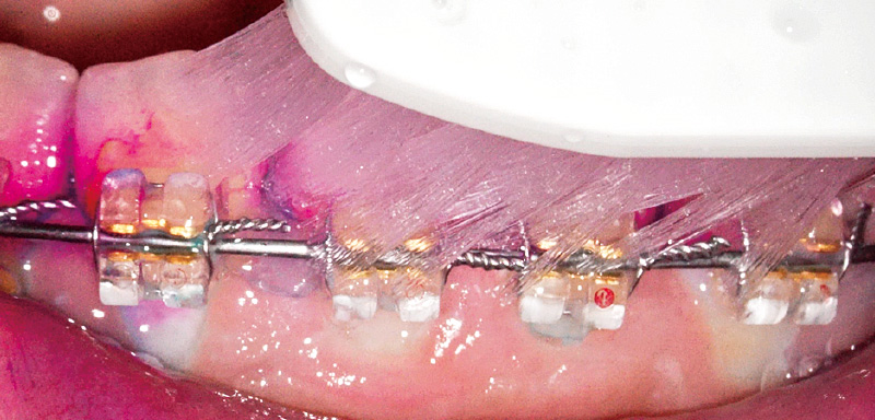 [写真] 細部に毛先が到達するが、毛が細くしなるため毛先が広がり歯肉に当たる傾向がある