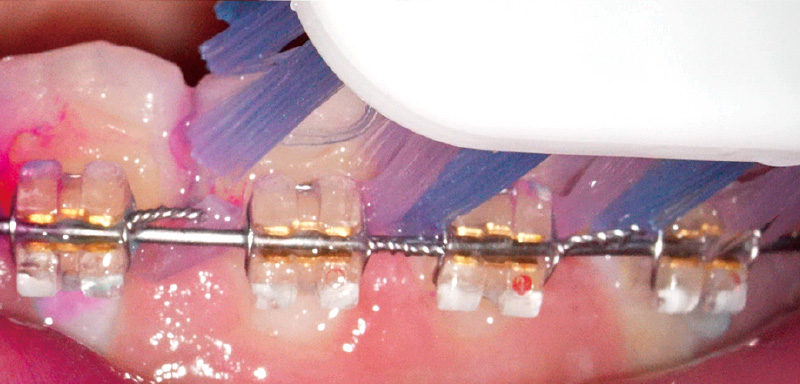 [写真] ブラケット周囲や歯面のプラークを効果的に除去できる