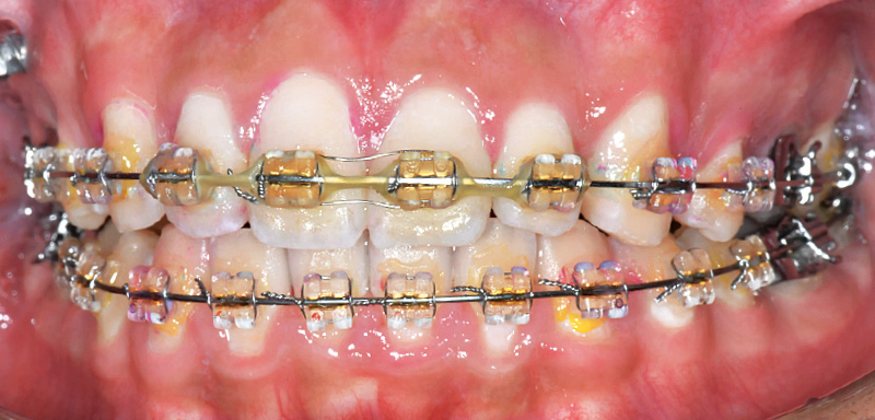 [写真] ブラケット周囲までプラークが除去できていることが確認できる