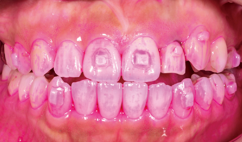 [写真] 「ソニッケアー」導入後の歯面のプラークの付着状態（「ソニッケアー」によるブラッシング前）