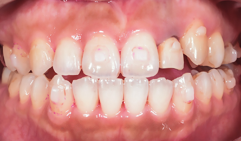 [写真] 「ソニッケアー」によるブラッシング直後（替ブラシは「プレミアムオールインワンブラシ」を使用）