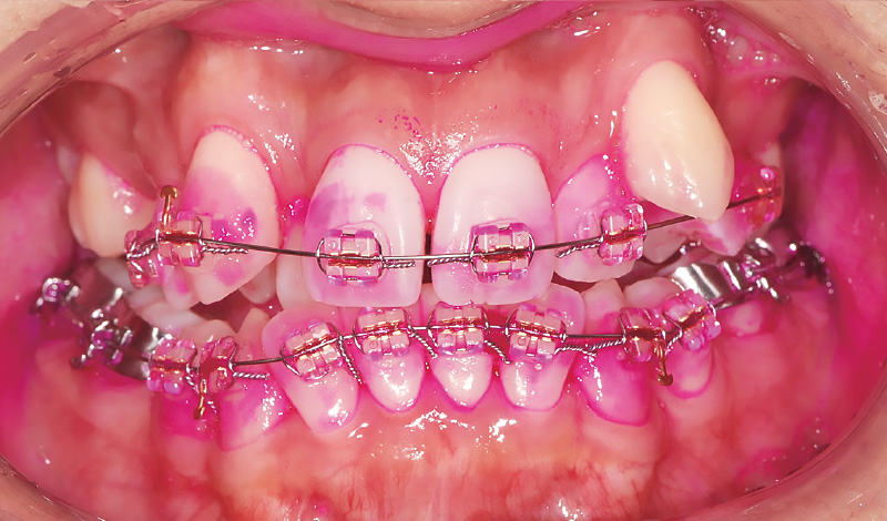 [写真] ワイヤー矯正中の10代女性