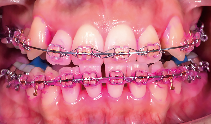 [写真] 「ソニッケアー」導入後のブラッシング前（正面観）