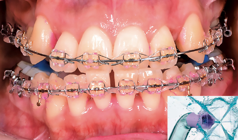 [写真] 「パワーフロッサー」によるプラーク除去後