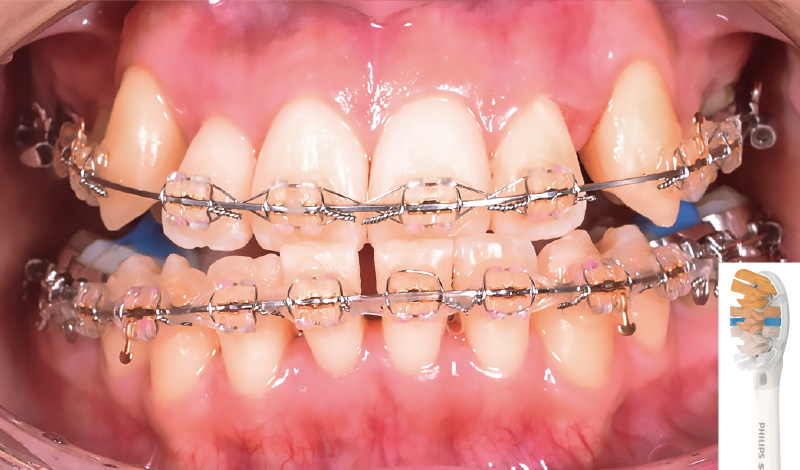 [写真] ブラケット周辺のプラークはさらに除去されている