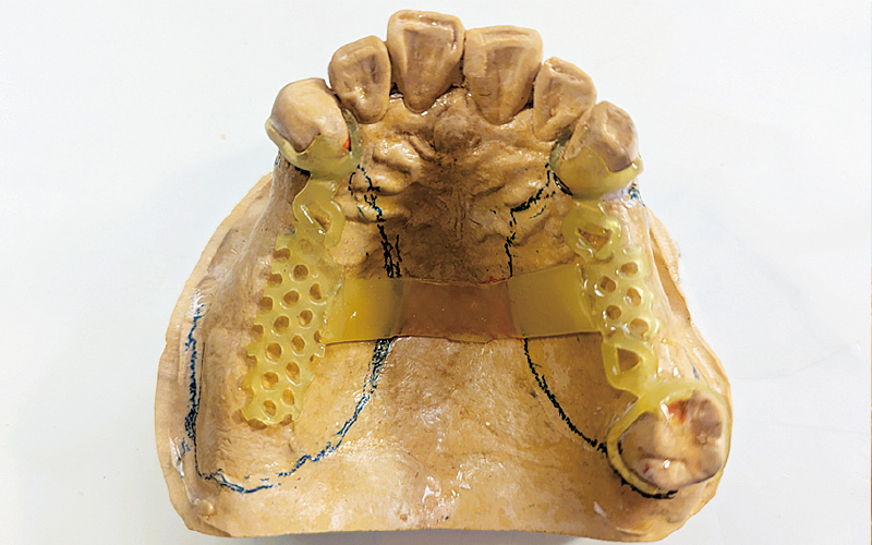 [写真] メタルフレームのためのパターン作製