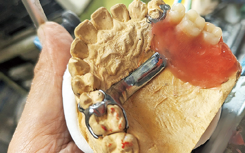 [写真] 症例の試適の様子