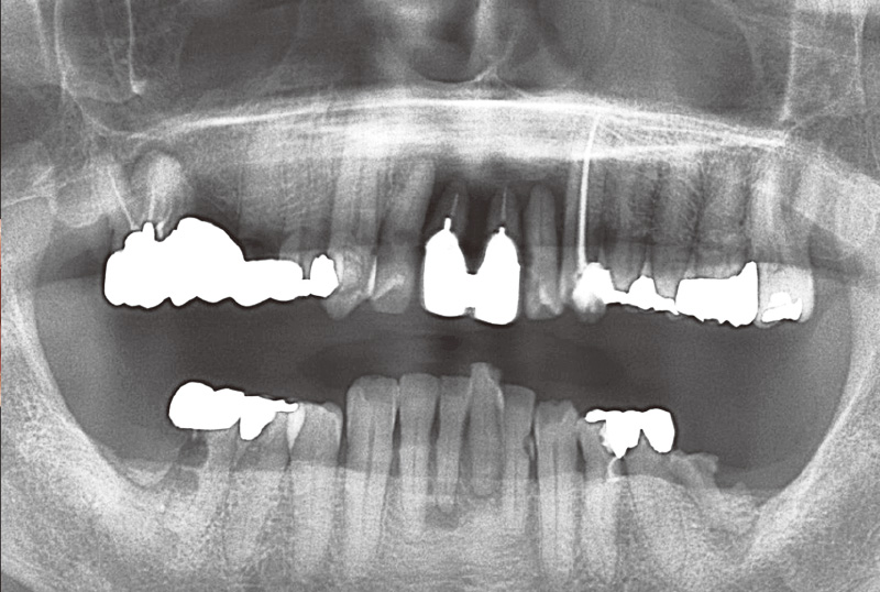 [写真] 初診時のパノラマX線画像