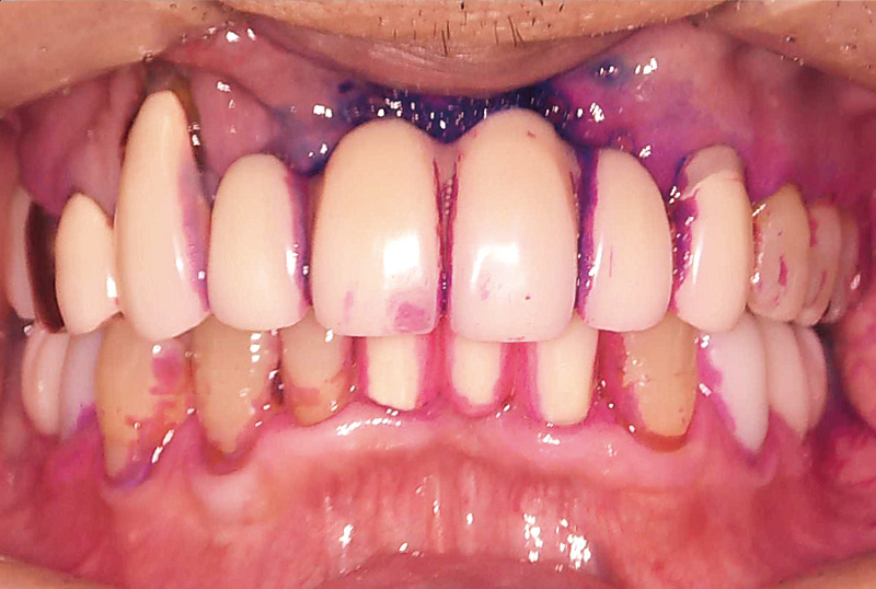 [写真] 初診から6年後の染め出し写真