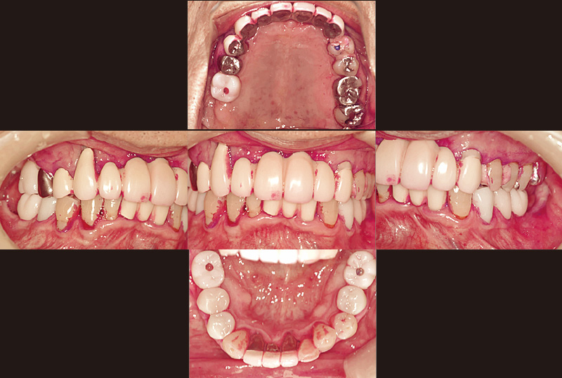 [写真] 図4から1か月半後に再度染め出しを行ったところ