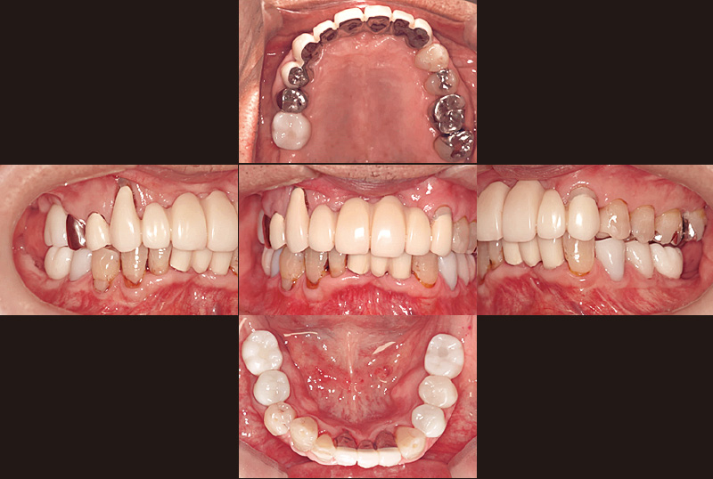 [写真] デジタルスキャンから約2か月半後の口腔内の状態