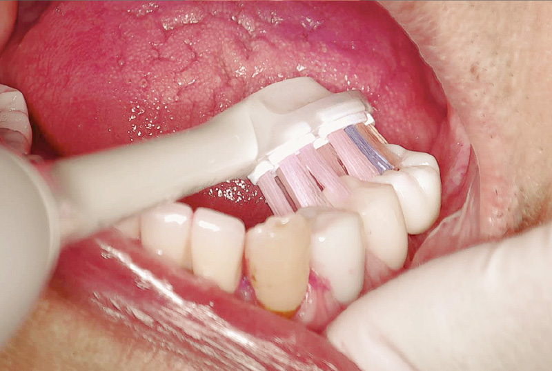 [写真] 「プレミアムオールインワンブラシ」を使用し歯磨きをする様子